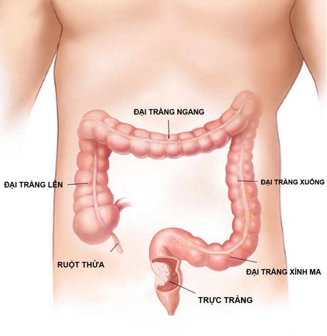 Hiểu đúng giúp giảm nỗi lo viêm đại tràng